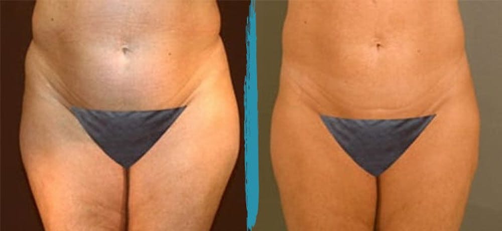 Vaser Lipo Before & After Gallery - Patient 18616212 - Image 1