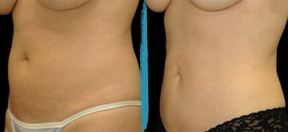 Vaser Lipo Before & After Gallery - Patient 18616213 - Image 1