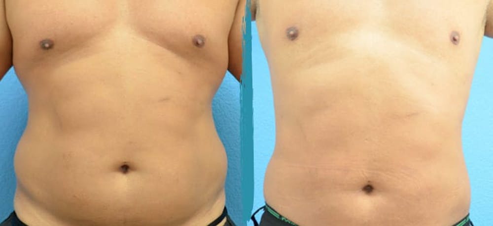 Vaser Lipo Before & After Gallery - Patient 18616214 - Image 1