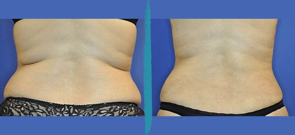 Vaser Lipo Before & After Gallery - Patient 18616215 - Image 1