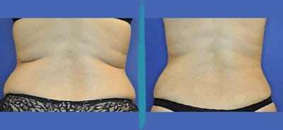 Vaser Lipo Before & After Gallery - Patient 18616215 - Image 1