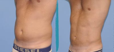Vaser Lipo Before & After Gallery - Patient 18616216 - Image 1