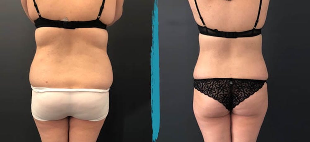 Vaser Lipo Before & After Gallery - Patient 18616217 - Image 1