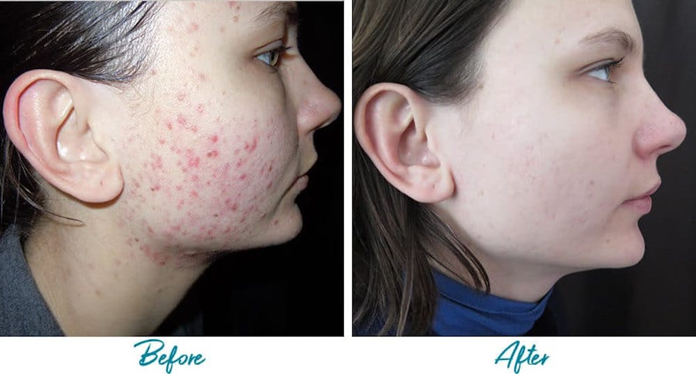 Patient 18616220 Acne Scars Before And After Photos Alinea Medical Spa Acne Scar And Laser Skin Care