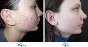 Acne Scar Removal results in NYC at Alinea Medical Spa