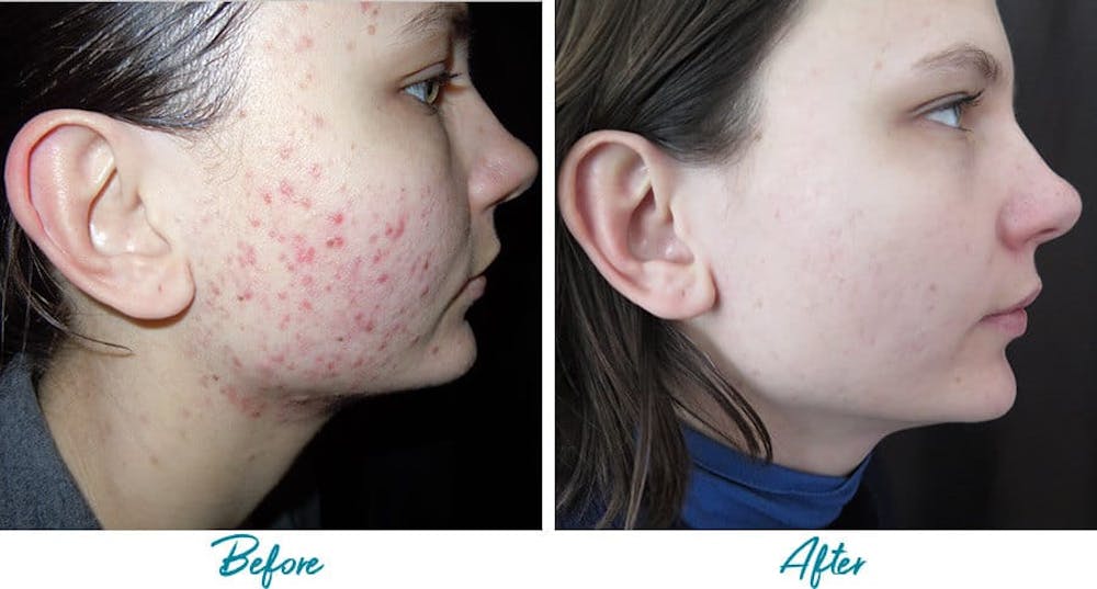 Trofast Afslut terrorist Patient 18616220 | Acne Scars Before & After Photos | Alinea Medical Spa Acne Scar & Laser Skin Care Trofast Afslut terrorist Patient 18616220 | Acne Scars Before & After Photos | Alinea Medical Spa Acne Scar & Laser Skin Care