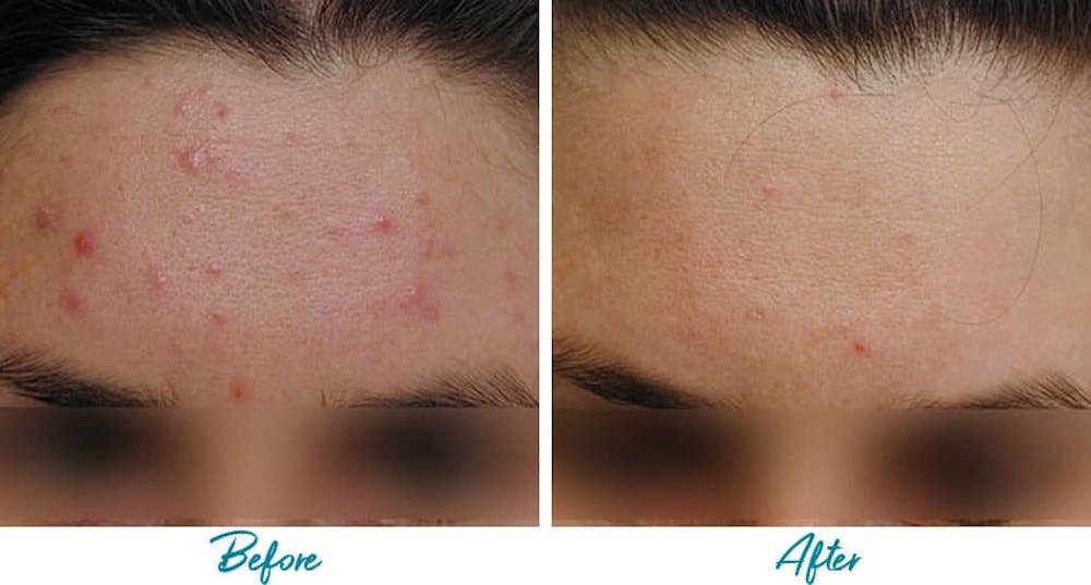 Acne Scars Before & After Gallery - Patient 18616221 - Image 1
