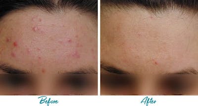 Acne Scars Before & After Gallery - Patient 18616221 - Image 1