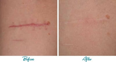 Acne Scars Before & After Gallery - Patient 18616222 - Image 1