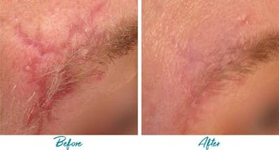 Acne Scars Before & After Gallery - Patient 18616223 - Image 1