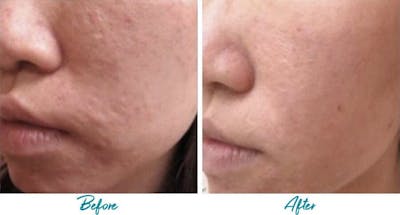 Acne Scars Before & After Gallery - Patient 18616224 - Image 1