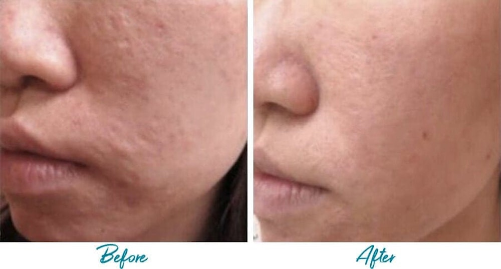 Acne Scar Removal results in NYC