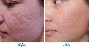 Acne Scar Removal results in NYC