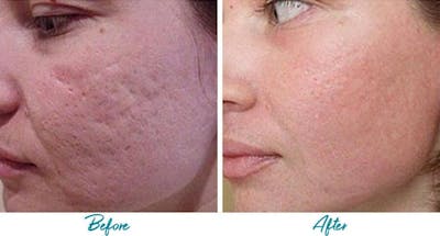 Acne Scars Before & After Gallery - Patient 18616225 - Image 1