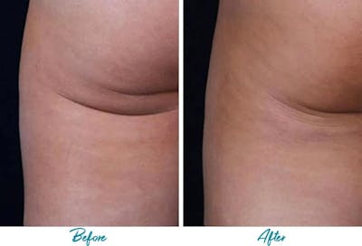 Profound RF Cellulite Before & After Gallery - Patient 18616340 - Image 1