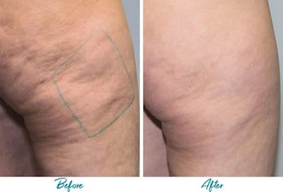 Profound RF Cellulite Before & After Gallery - Patient 18616341 - Image 1