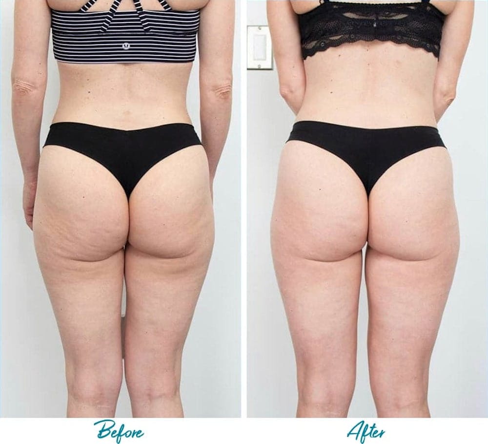 Profound RF Cellulite Before & After Gallery - Patient 18616342 - Image 1