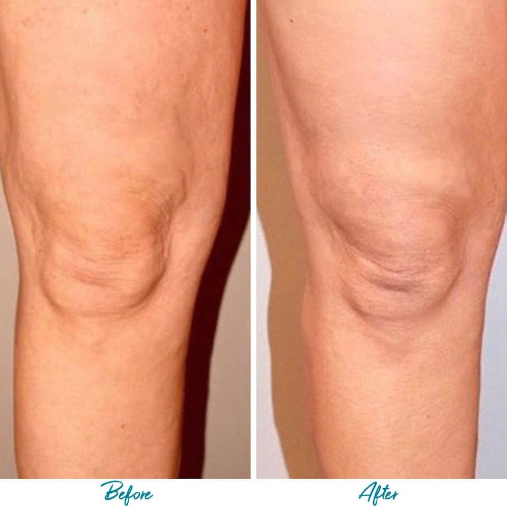 Profound RF Cellulite Before & After Gallery - Patient 18616344 - Image 1