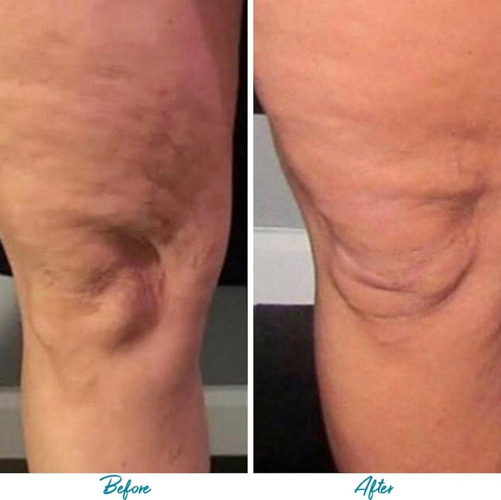 Profound RF Cellulite Before & After Gallery - Patient 18616345 - Image 1