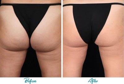 Profound RF Cellulite Before & After Gallery - Patient 18616346 - Image 1