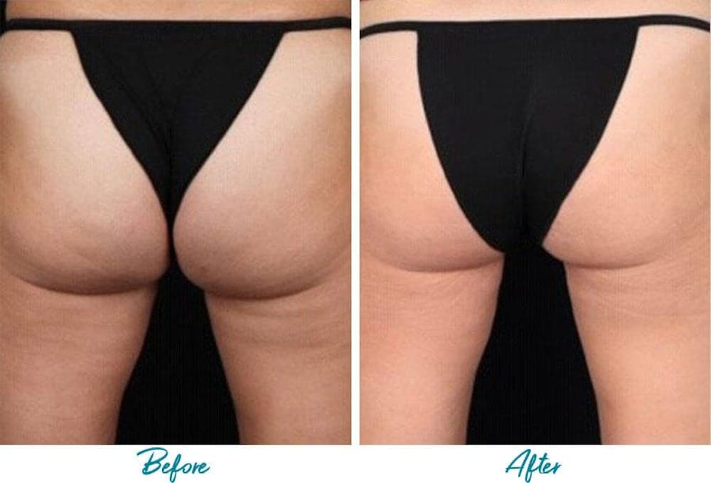 Profound RF Cellulite Before & After Gallery - Patient 18616346 - Image 1