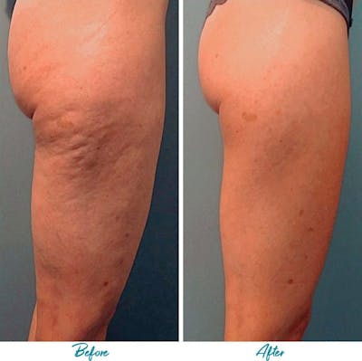 Profound RF Cellulite Before & After Gallery - Patient 18616347 - Image 1