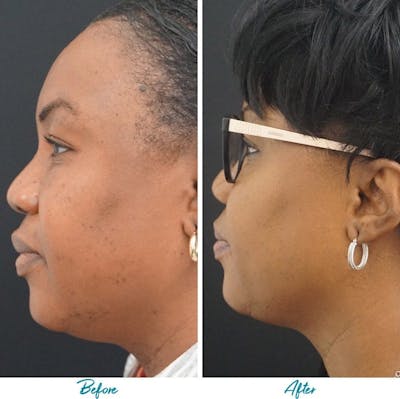 Profound RF Skin Tightening Before & After Gallery - Patient 18616379 - Image 1