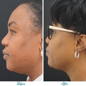 Before and after Profound skin tightening in NYC