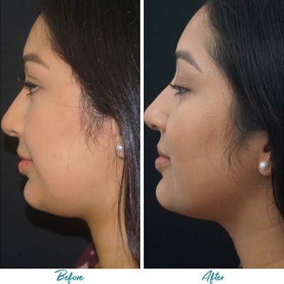 Profound RF Skin Tightening Before & After Gallery - Patient 18616380 - Image 1