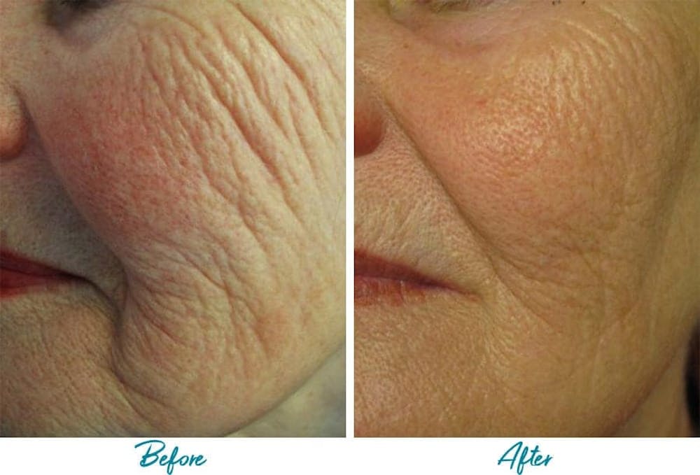 Profound RF Skin Tightening Before & After Gallery - Patient 18616381 - Image 1