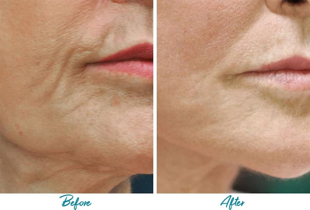 Patient 18616382 Profound Rf Skin Tightening Before And After Photos