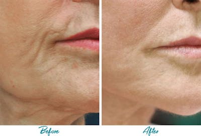 Profound RF Skin Tightening Before & After Gallery - Patient 18616382 - Image 1