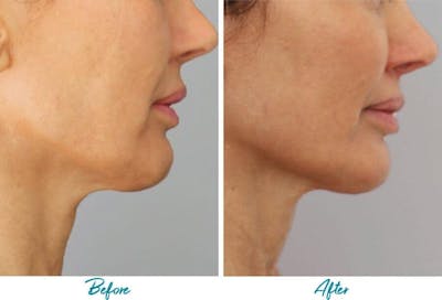 Profound RF Skin Tightening Before & After Gallery - Patient 18616383 - Image 1