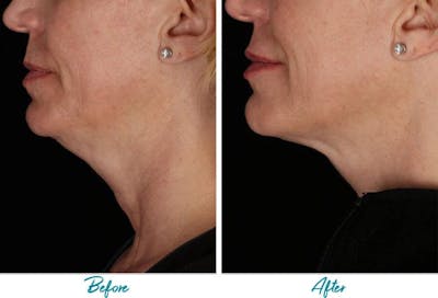 Profound RF Skin Tightening Before & After Gallery - Patient 18616384 - Image 1