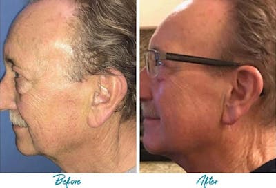 Profound RF Skin Tightening Before & After Gallery - Patient 18616385 - Image 1