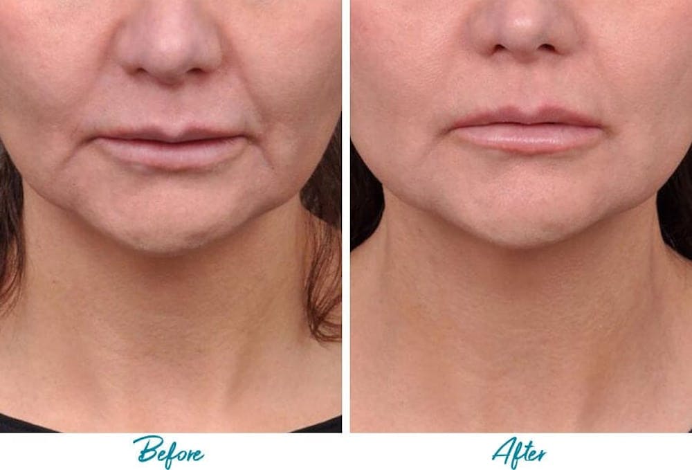 Profound RF Skin Tightening Before & After Gallery - Patient 18616386 - Image 1