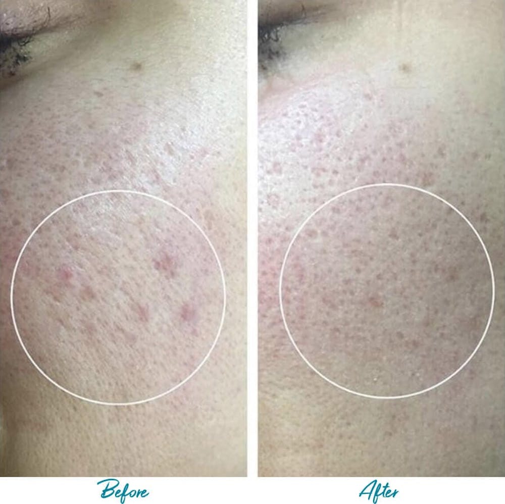 Acne Scars Before & After Gallery - Patient 18616517 - Image 1