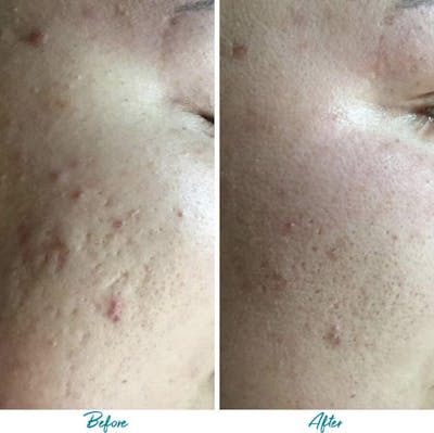 Acne Scars Before & After Gallery - Patient 18616518 - Image 1