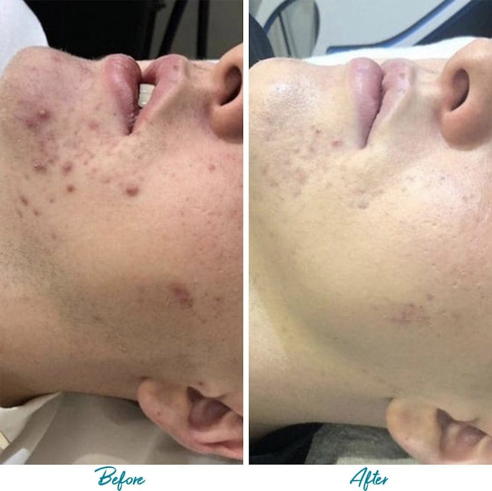 Acne Scars Before & After Gallery - Patient 18616519 - Image 1