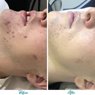 Acne Scars Before & After Gallery - Patient 18616519 - Image 1