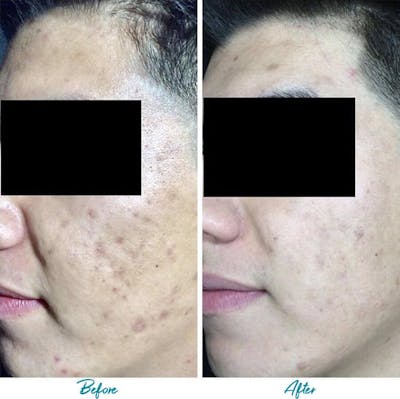 Acne Scars Before & After Gallery - Patient 18616520 - Image 1