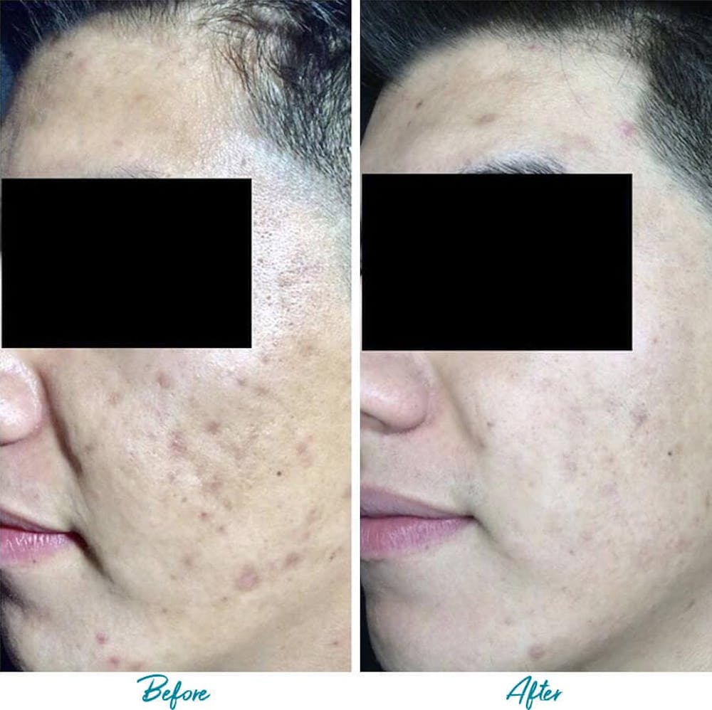 Acne Scars Gallery - Patient 18616520 - Image 1