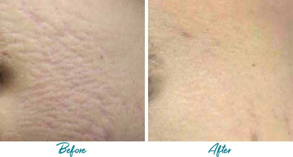 Acne Scars Before & After Gallery - Patient 18616521 - Image 1