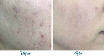 Acne Scars Before & After Gallery - Patient 18616522 - Image 1