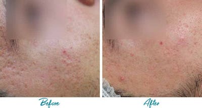 Acne Scars Before & After Gallery - Patient 18616523 - Image 1