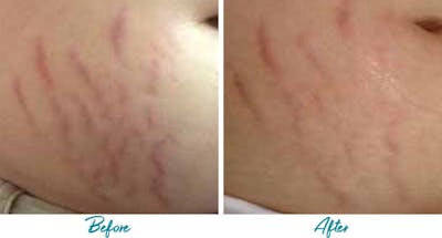 Acne Scars Before & After Gallery - Patient 18616524 - Image 1