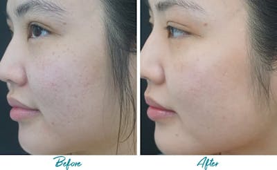 Acne Scars Before & After Gallery - Patient 18616525 - Image 1