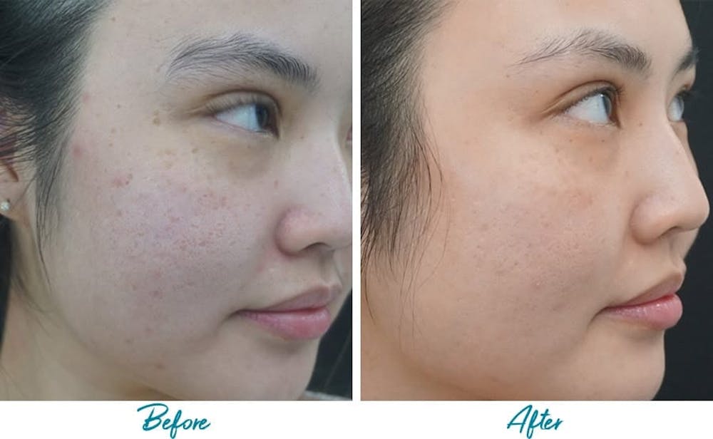 Acne Scars Before & After Gallery - Patient 18616525 - Image 2
