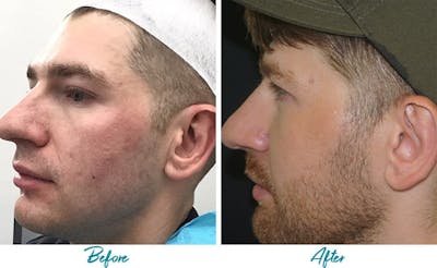 Acne Scars Before & After Gallery - Patient 18616526 - Image 2