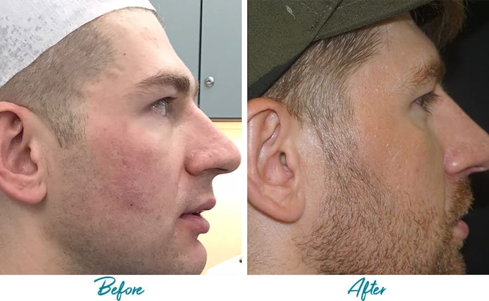 Acne Scars Before & After Gallery - Patient 18616526 - Image 3
